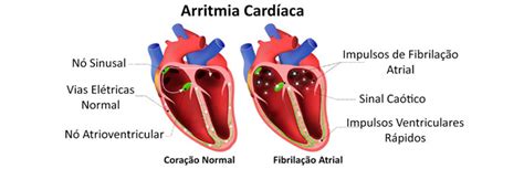 cid arritmia cardíaca tipos